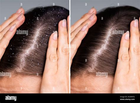 difference  hair  dandruff stock photo alamy