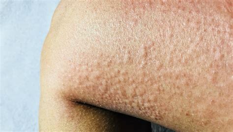 Alergia A Areia Da Praia