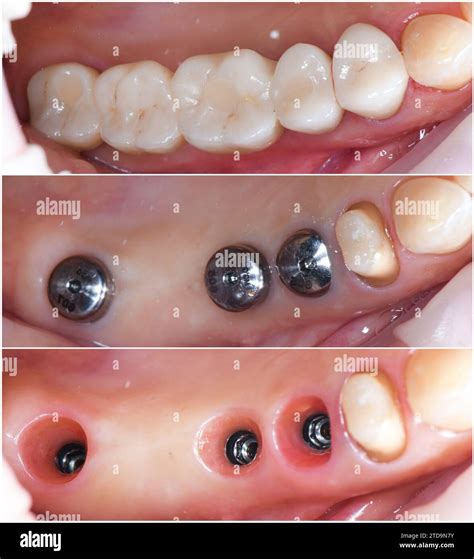 Emax crowns and veneers Stock Photo - Alamy