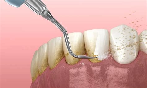 dental plaque build        teeth health fenix