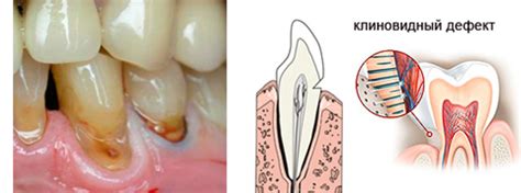 Клиновидный дефект зуба - Энциклопедия стоматологии DentalMechanic.ru