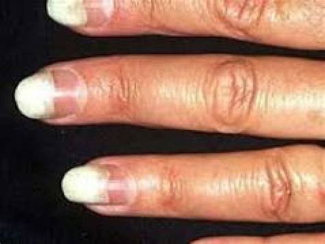 Onycholysis Nails | Mumsnet