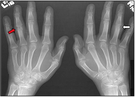 psoriatic arthritis  diagnosis  treatment