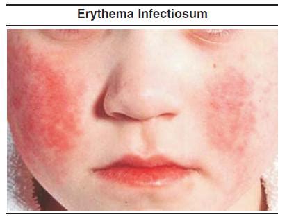 Erythema Infectiosum Adults