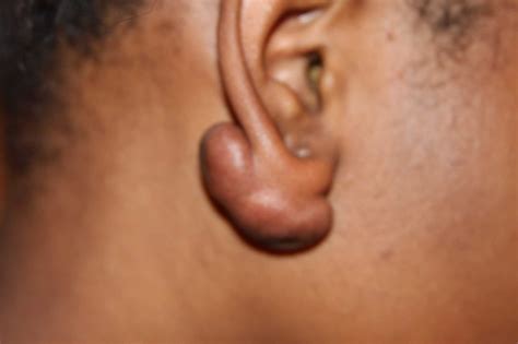 keloid scar removal drderme skin clinics