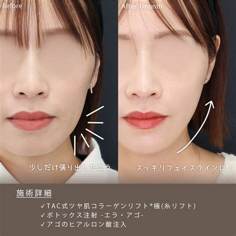 「ボトックス注射」でエラ張りを解消！美しいフェイスラインに｜症例写真・ビフォーアフター｜美容整形･美容外科のTAクリニックグループ