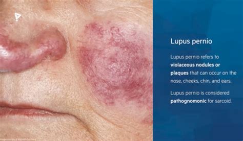 Lupus Pernio Pictures