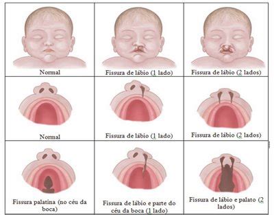 Labio Leporino Fenda Palatina - FONOAUDIÓLOGA RJ - DRA. ROBERTA PEREIRA: Lábio Leporino e/ou Fenda Palatina