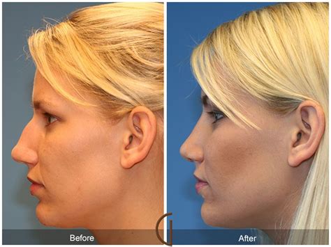 Before and After Rhinoplasty Gallery | Rhinoplasty, Nose job ...