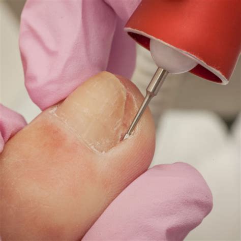 Nail Surgery | Dr Sunil Mishra