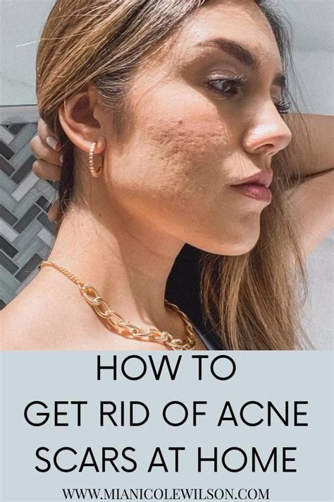 scar removal treatment  delhi scar removal results