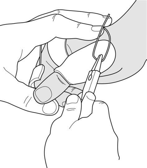 Guide Functional ulnar nerve splint and combined ulnar median nerve splint