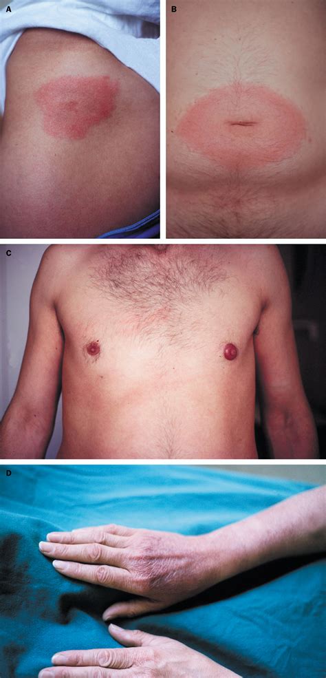 Lyme borreliosis - The Lancet