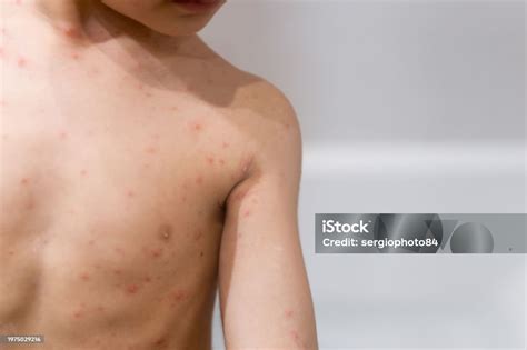 boy  chickenpox rash  child body close  stock photo