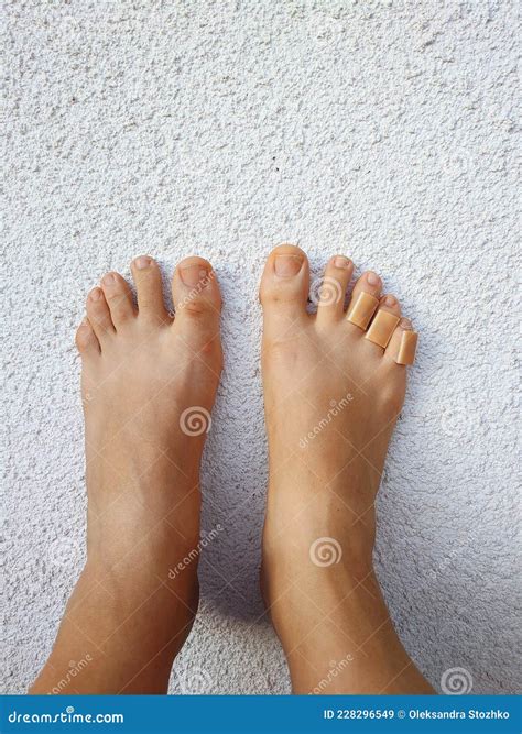 Woman`s Legs with a Plasters To a Callus on Toes. Foot Skin Care and