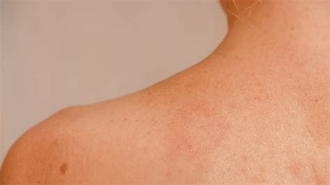 Christmas Tree Rash Pityriasis Rosea Treatment at Hilda Lefebre blog