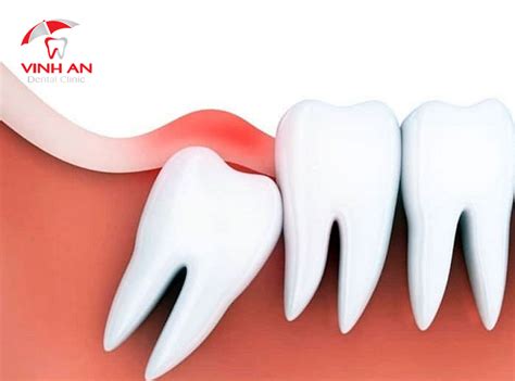 giai dap nhung thac mac pho bien ve viem nuou quanh rang khon