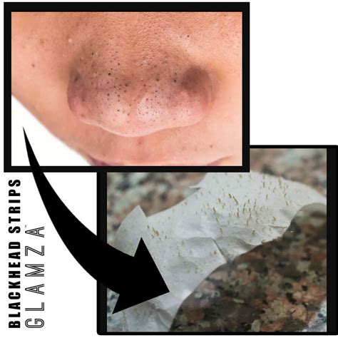 Blackhead Removal Strips Nose Face Mask Deep Cleansing Pore Treatment ...