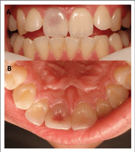 Figure 2 from Tooth root resorption: A review | Semantic Scholar