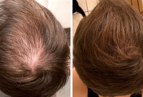 3 Best Red Light Therapy Hair Growth Devices That Do Work [2023 ...