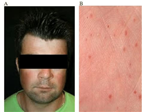 Nevoid Basal Cell Carcinoma Syndrome