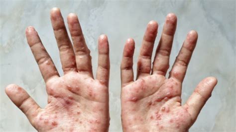 Stiglo je uputstvo lekarima zbog majmunskih boginja – šta sve sadrži? - B92