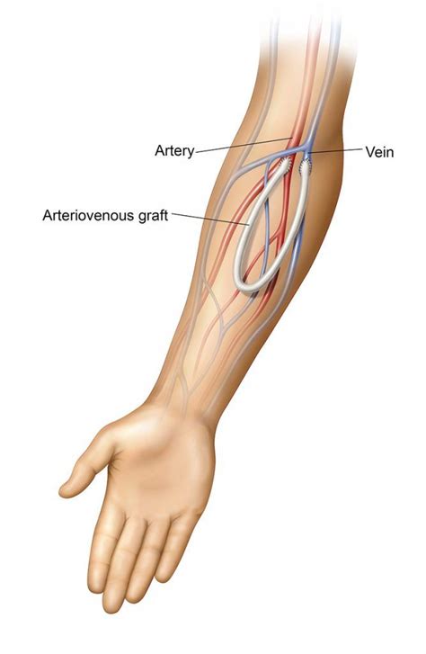 AV Graft Creation for Dialysis | AV Graft Placement