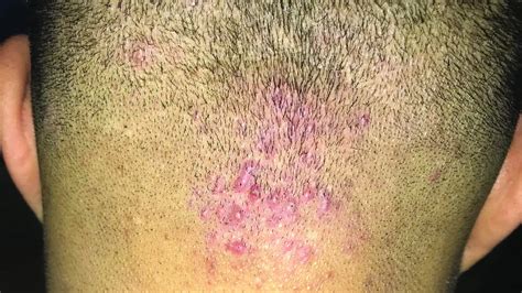 Furunculosis Neck
