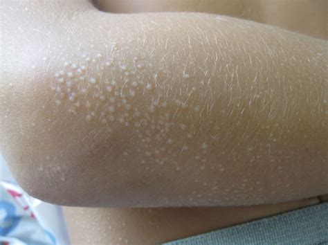 Toddler Skin Rash White Bumps at Janine Hall blog