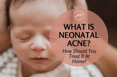 What Is Neonatal Acne? How Should You Treat It At Home?