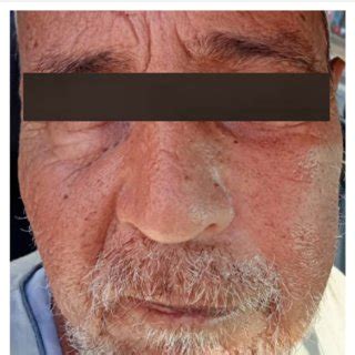 mild asymmetric left cheek swelling    early clinical