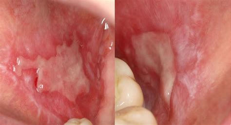 Oral Lichen Planus? : r/Lichenplanus