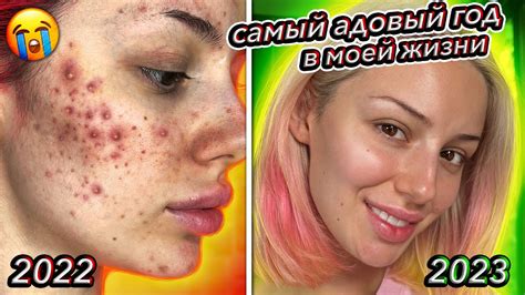 КАК Я ВЫЛЕЧИЛА ПРЫЩИ? - YouTube