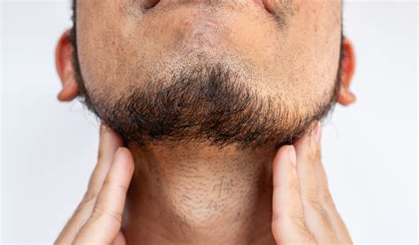 TikTok: Women Get Beard-Related Infection From Kissing