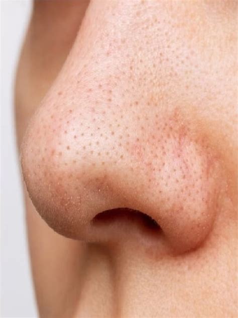 remove blackheads blk  ko   aasan trk