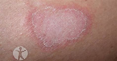 Annular erythema close-up image