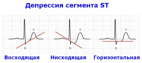 36. Инфаркт миокарда без подъема сегмента ST (NSTEMI)