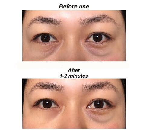 how to fix under eye bags