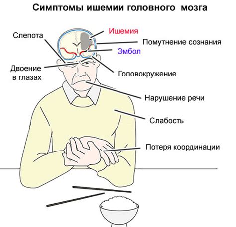 Ишемия головного мозга: что это такое, коды МКБ, острая и хроническая ...