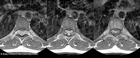 The Spine: Hemangioma Of The Spine