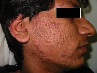 Severe Acne Scars - Best option? (photo) Doctor Answers, Tips