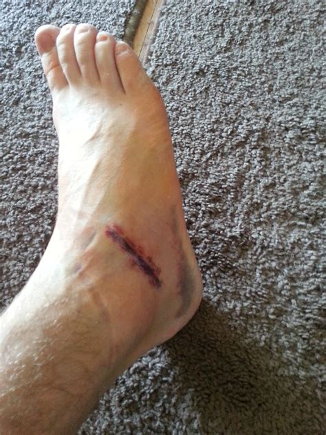 Tarsal Coalition: Walking Boot and physical therapy