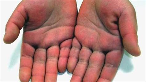 Toxic Shock Syndrome Rash On Palms