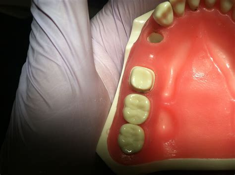 19 crown prep Mesial distal margin break. Too close to gingiva 1.0mm