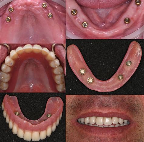 Имплантология и лечение с импланти | ROI Dental Clinic