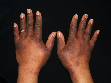 Eczema Symptoms & Causes | National Eczema Association
