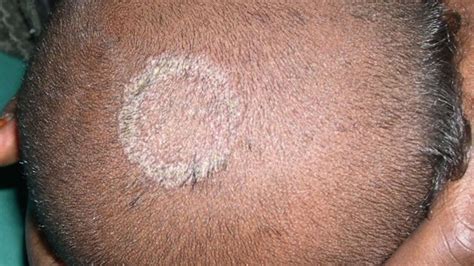Tinea Capitis