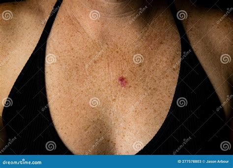 Basal Cell Carcinoma, Light Micrograph Stock Photo | CartoonDealer.com ...