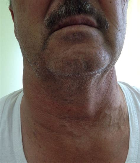 Swollen Tonsils Neck