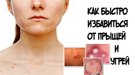 Как быстро избавиться от прыщей и угрей///Огурец+белок - YouTube